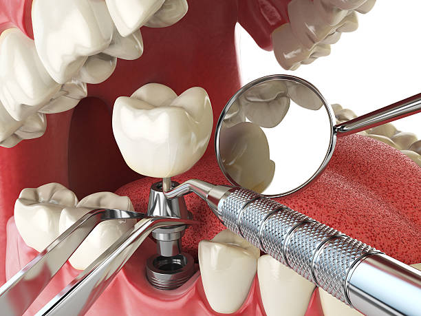 Best Emergency Dental Care for Broken or Chipped Teeth in Lenexa, KS
