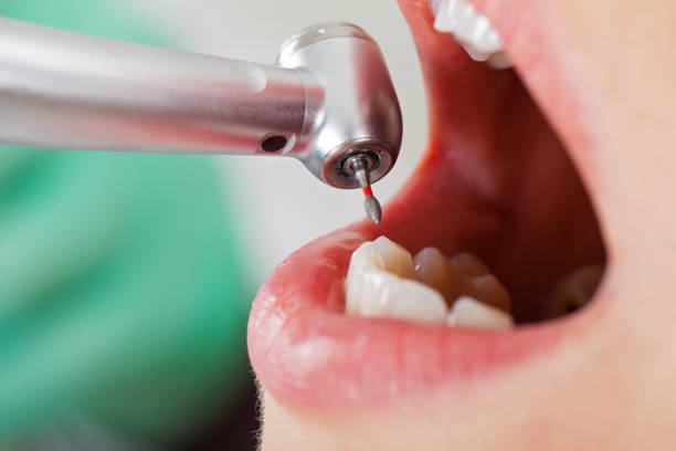 Best Emergency Tooth Extraction in Lenexa, KS